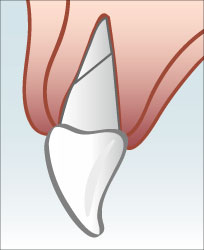 Die Wurzel des Schneidezahnes ist gebrochen.