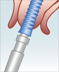 Das Implantat wird eingesetzt.