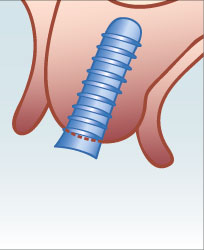 eingesetztes und vernähtes Implantat