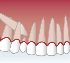 Freilegung von verlagerten Zähnen